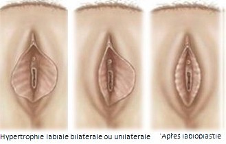 labiaplasty1.jpg labiaplasty1.jpg